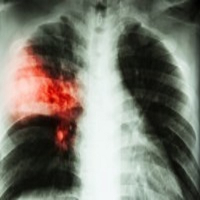 Lobar Pneumonia
